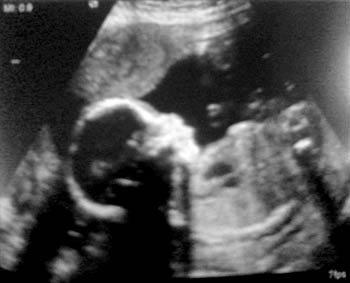 Ultrasound image of Claire's baby boy at 20 weeks